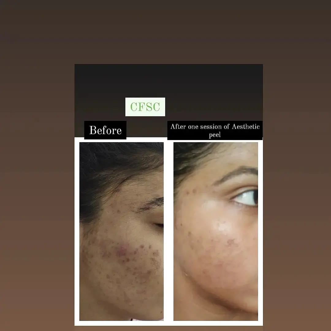 Before After Skin Treatment